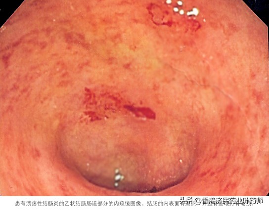 溃疡性结肠炎打生物制剂能治好吗,溃疡性结肠炎用生物剂可以治好吗