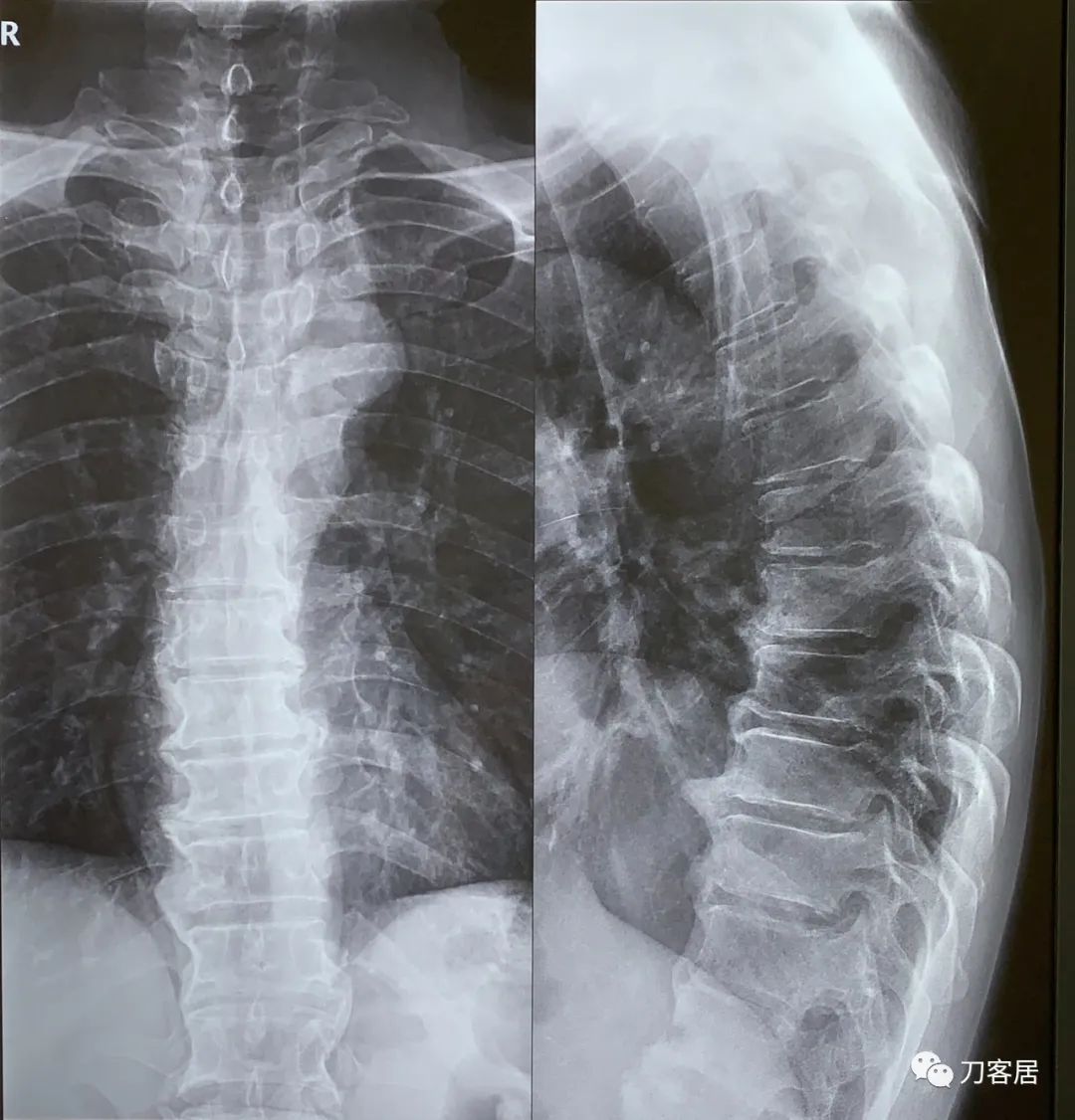 髋部疼，小腿肚胀、抽筋，折腾了5年没效果，能用阿仑膦酸钠吗？