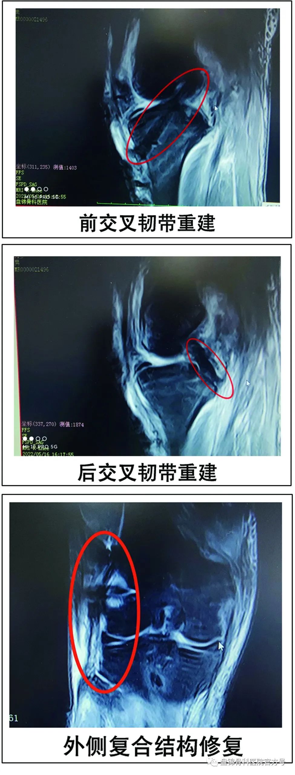 盘锦骨科医院治疗成功案例,盘锦骨科医院扩建