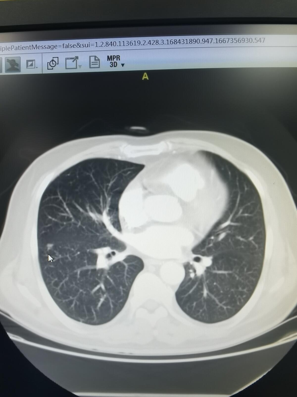 刘懿博士说肺癌化疗,刘懿博士说肺癌的书
