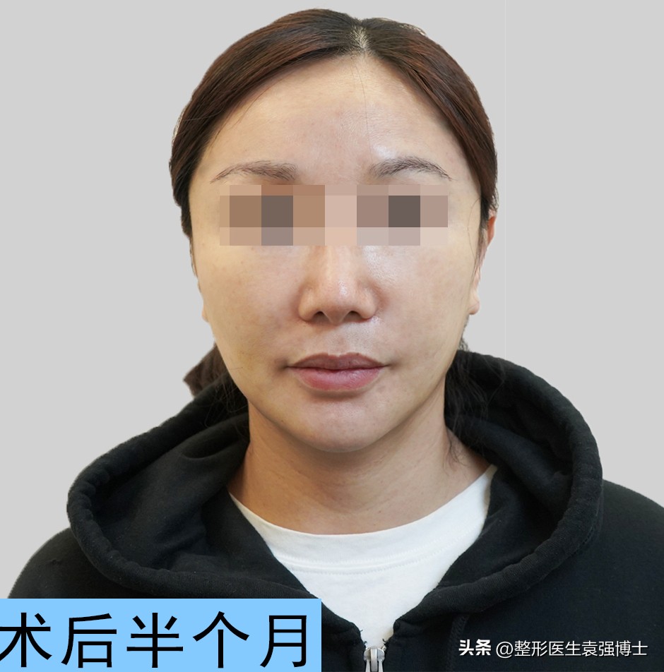 44岁女士拉皮除皱,50岁女人面部拉皮