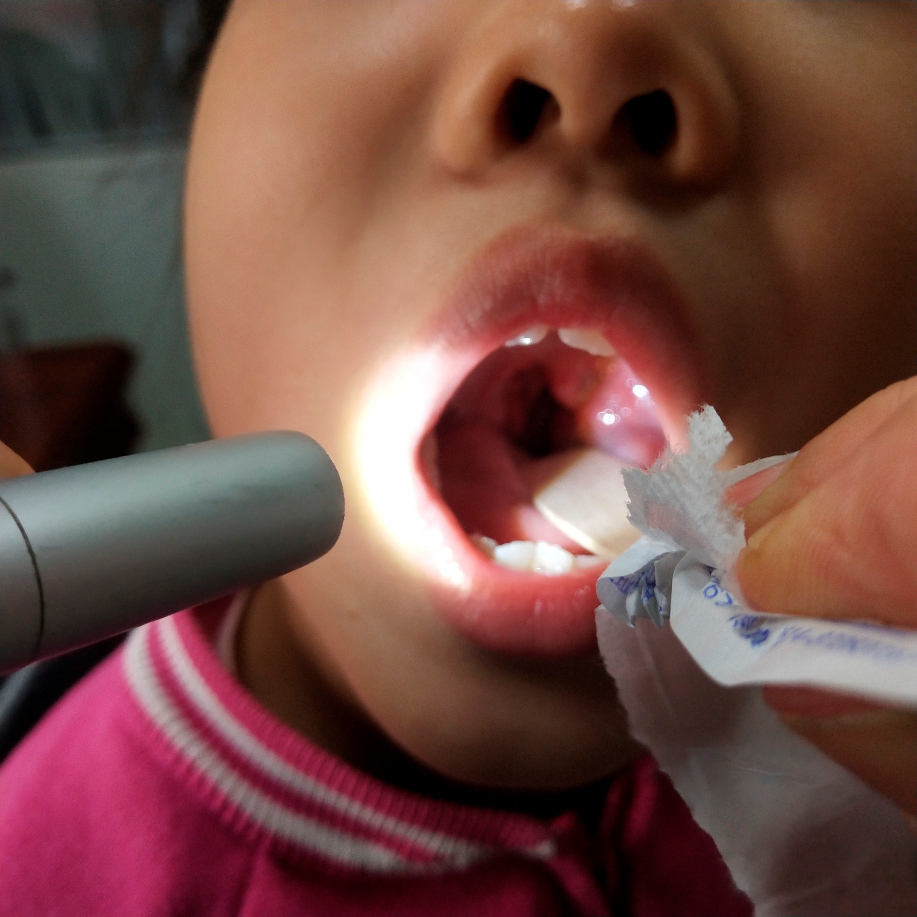 腺样体肥大除了手术还有什么办法,腺样体肥大除了切除还能怎么治