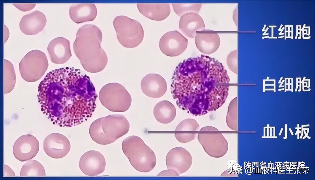 MDS“康复难”不仅是骨髓造血的问题，还有这三种原因