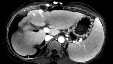重庆一妇女肚子巨大,女子肚大如球竟是5颗肿瘤