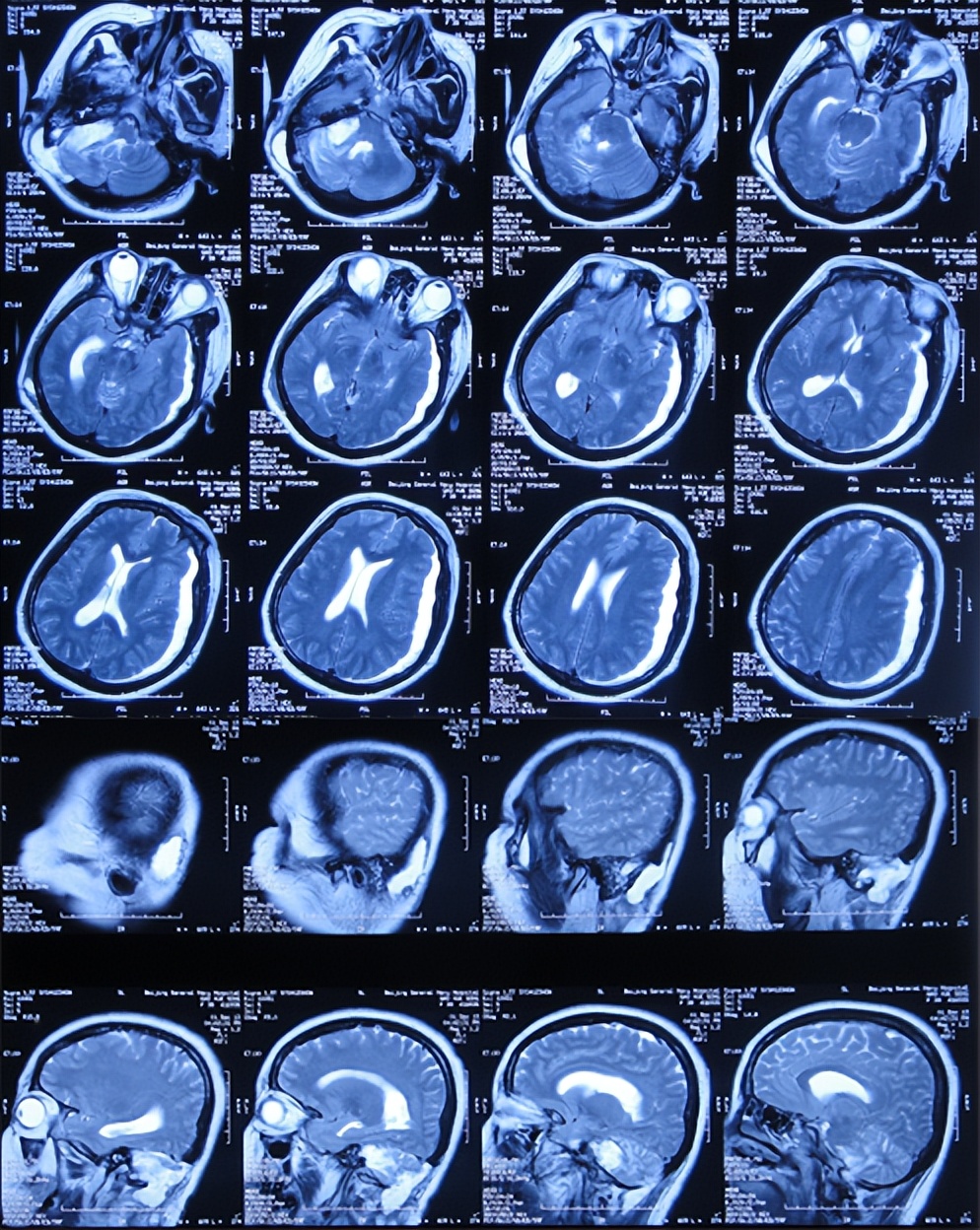 听神经瘤出现脑积水和出血,听神经瘤手术后颅压高症状