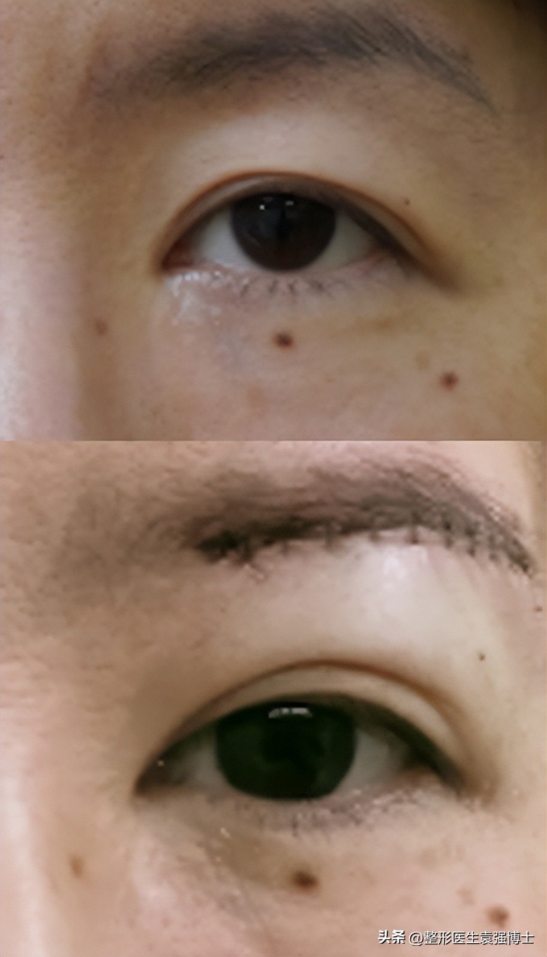 少年上眼皮松弛下垂的解决方法,年纪大眼皮下垂有什么好办法