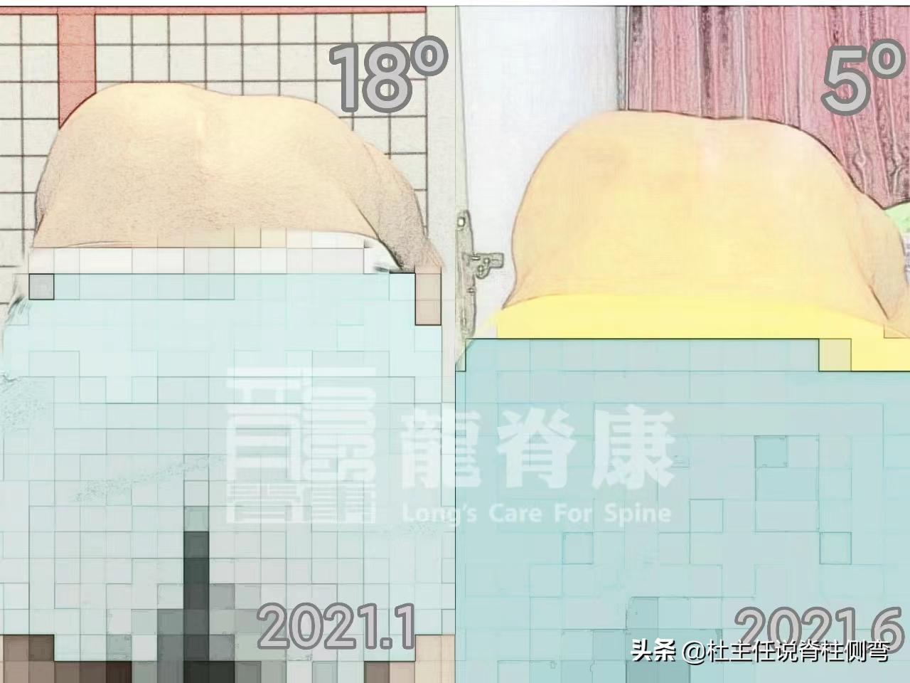 11至14岁青少年更易患脊柱侧弯,脊柱侧弯多少度会出现剃刀背