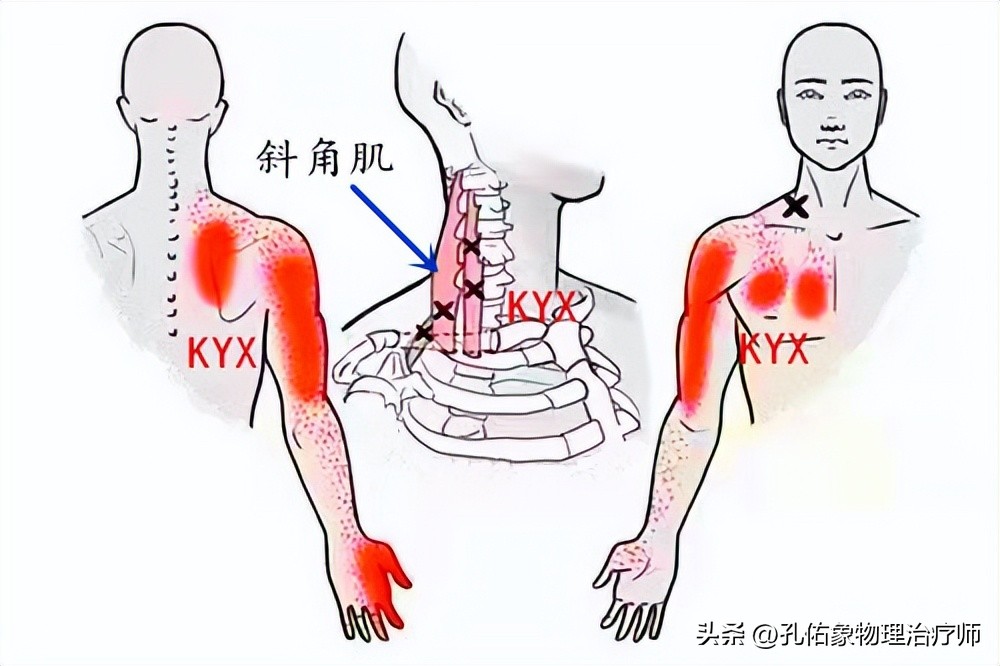 颈椎引起手麻胳膊腿无力,颈椎压迫神经胳膊无力手麻怎么治