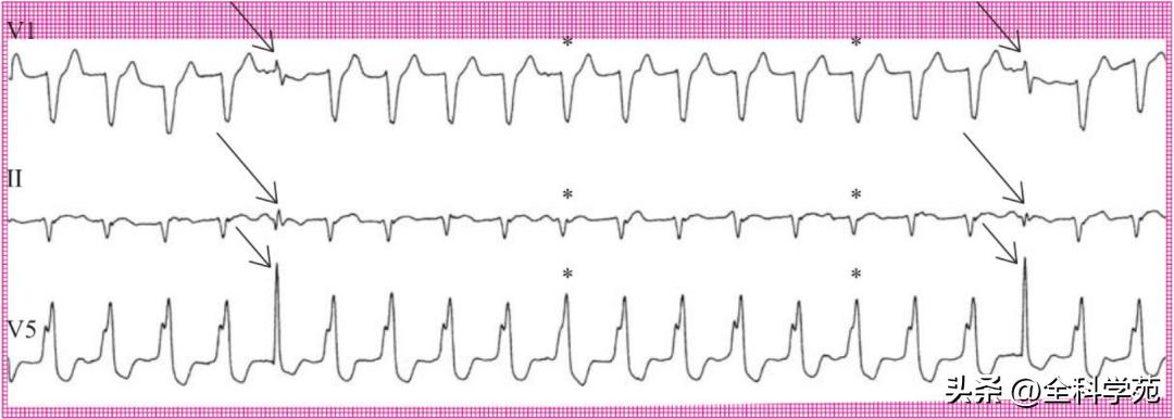 心电图上表现为宽qrs波,心电图中qrs是代表心动过速吗