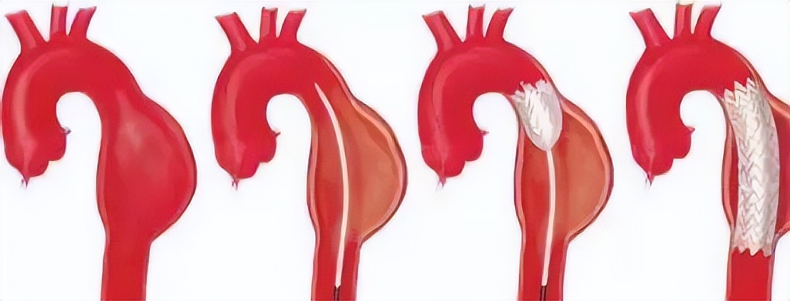 男子腹部剧痛检查意外肿瘤,男子腹痛难忍医生实施手术