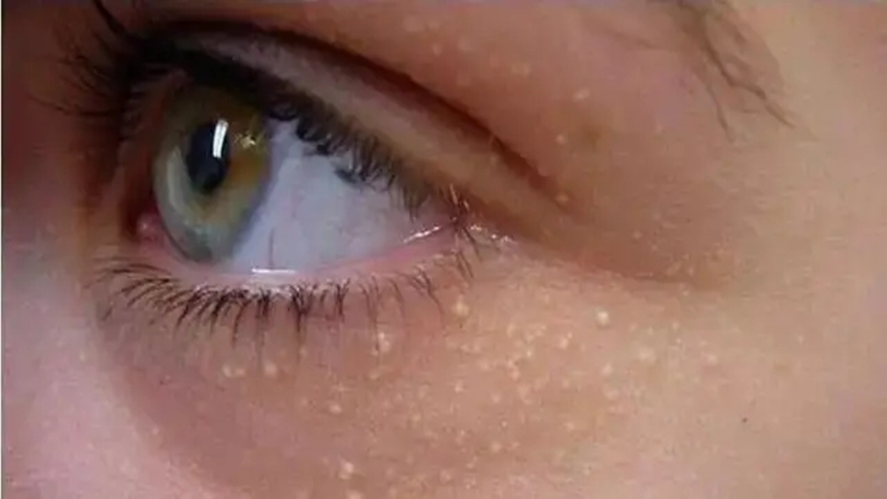 脸上、颈部、腋下的“肉疙瘩”是如何产生的？能用手抠掉吗？