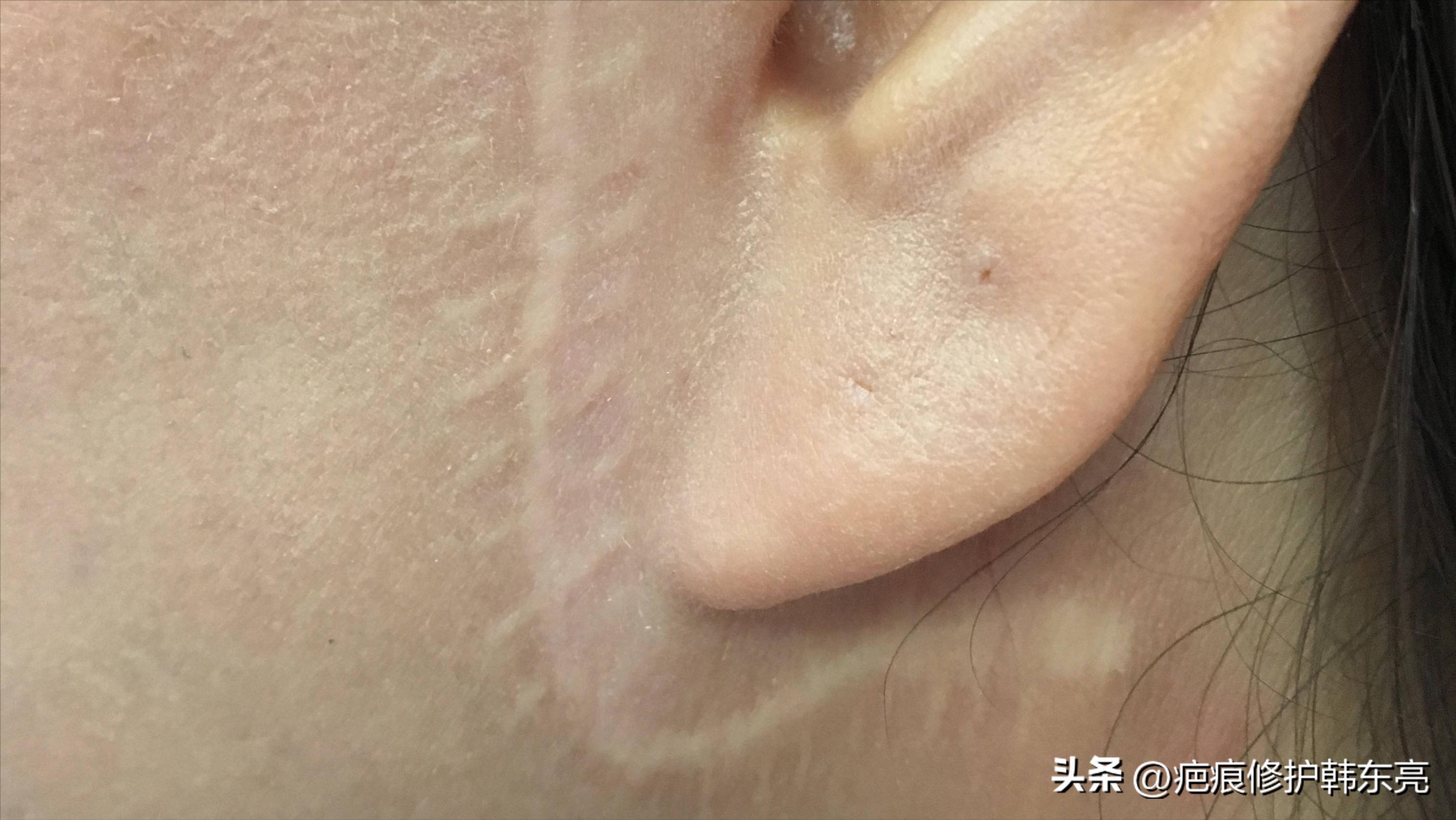 疤痕修复一次需要多少钱,上海九医院疤痕修复价目表2021