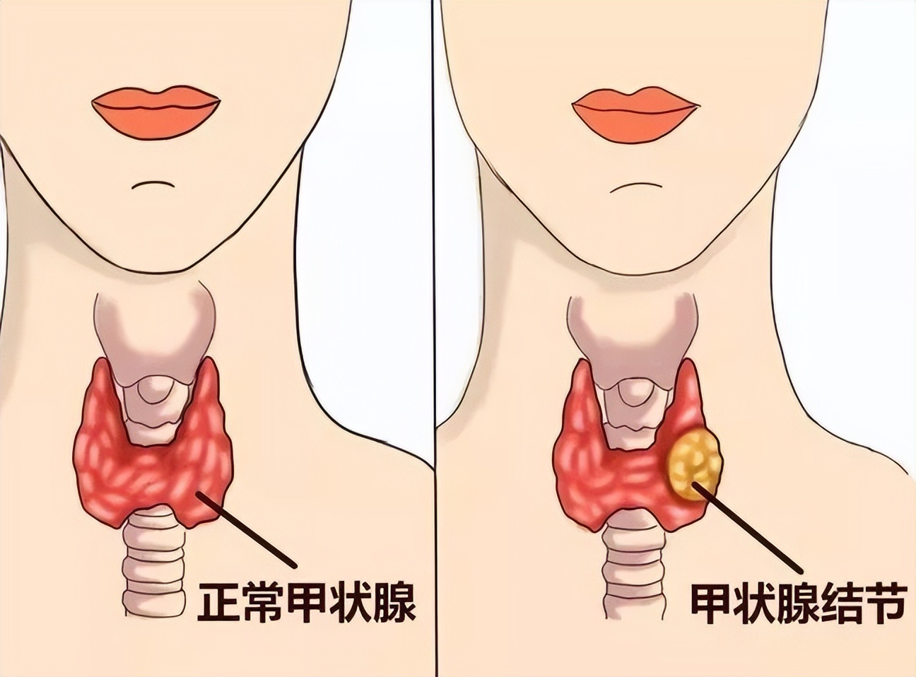 甲状腺结节癌变有哪些征兆？一旦癌变，中医如何治疗？
