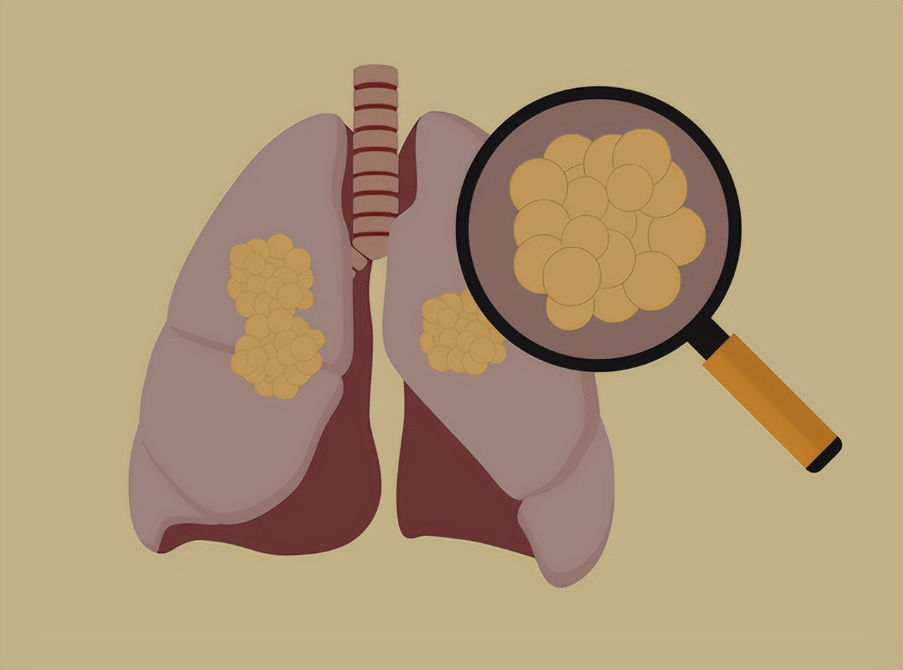 肺癌晚期加尿毒症晚期能活多久,肺癌晚期的症状一般还能活多久