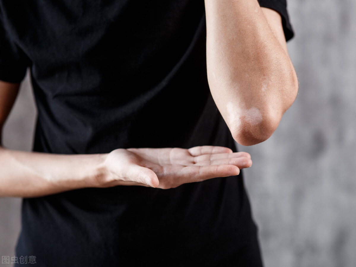 白癜风如何确诊和治疗,白癜风初步诊断方法