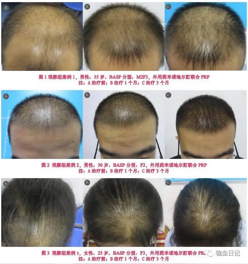 富血小板血浆治疗骨质增生吗,富血小板治疗脂溢性脱发