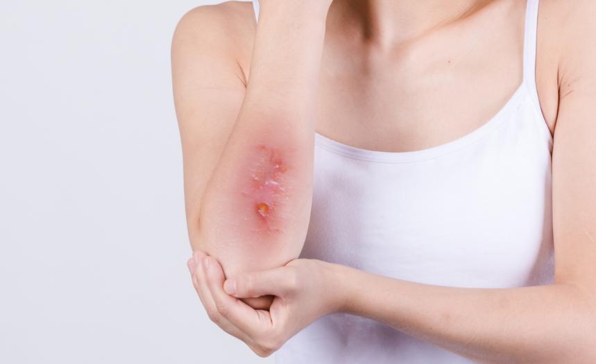 潜伏期梅毒能彻底治好吗,潜伏期的梅毒能治愈吗