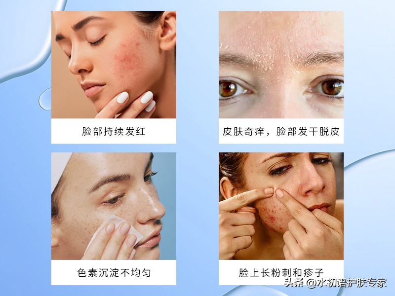 水初语祛痘技术,水初语修护敏感肌