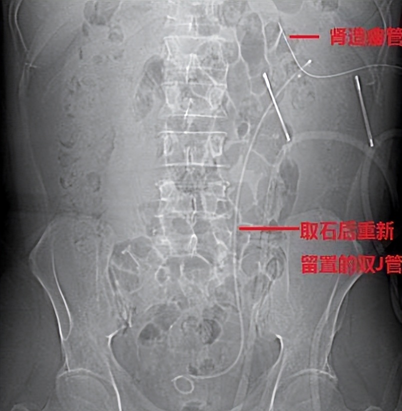 经皮肾镜取石术手术指征,经皮肾镜取石术并发症有哪些