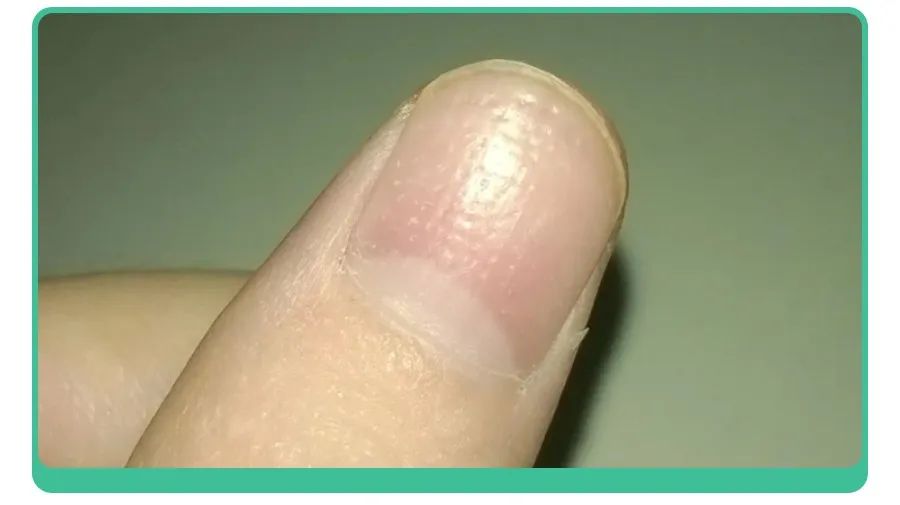 小孩指甲凹陷变黑有坑是什么原因,小孩指甲有白点和细纹是怎么回事