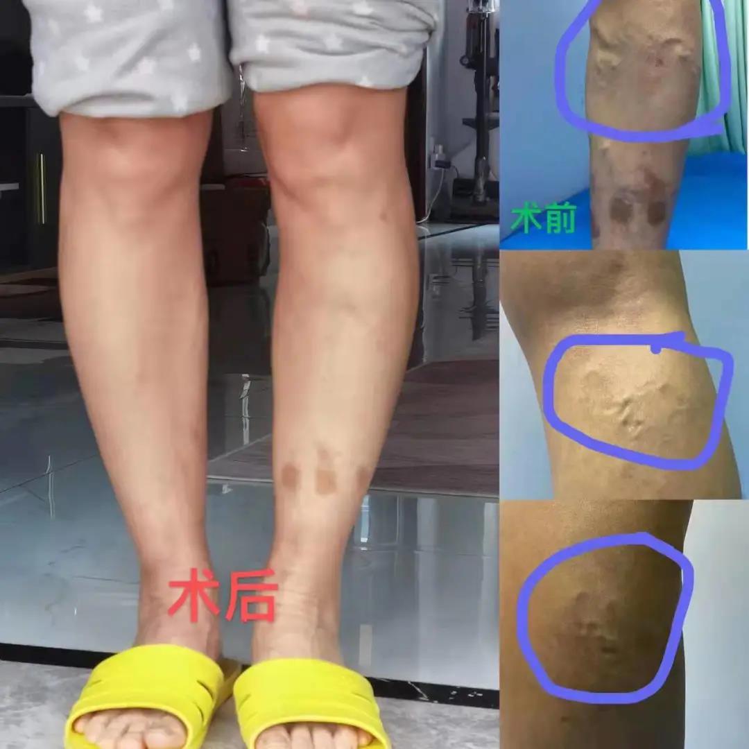 激光治疗下肢静脉曲张,精索静脉曲张微创和激光是一样吗