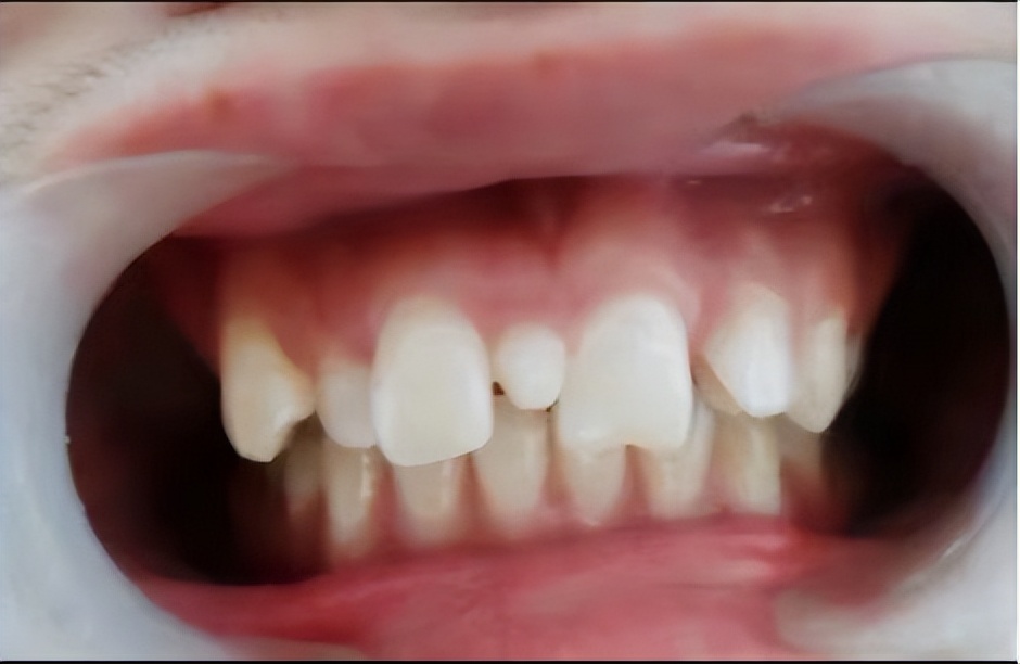 宝宝牙缝大是吃糖引起的吗,宝宝牙缝太宽了吧