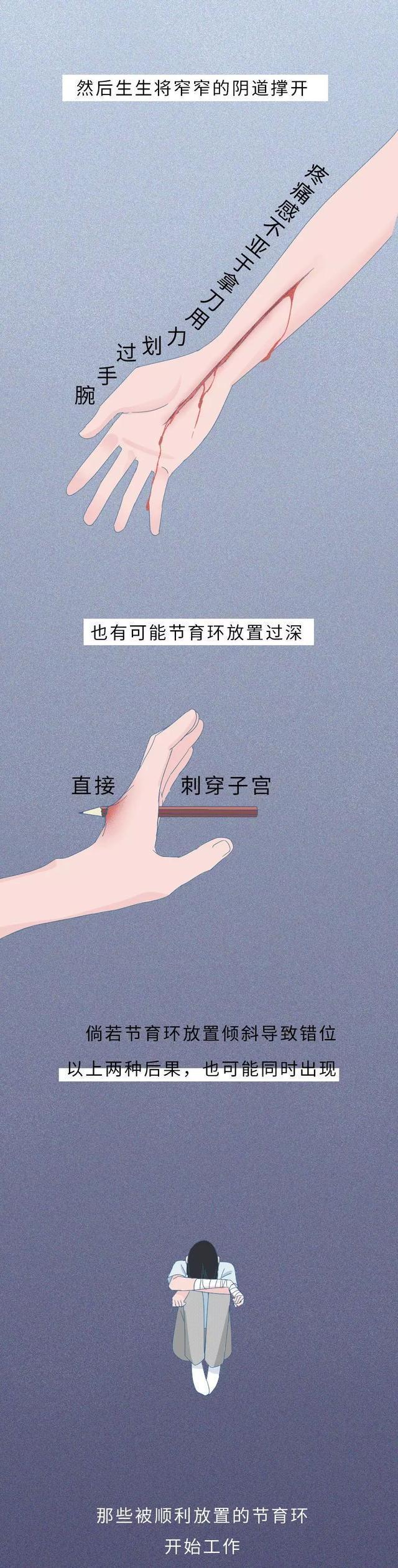 节育环有多可怕吗？在女性体内20年会有什么变化？没人能笑着看完