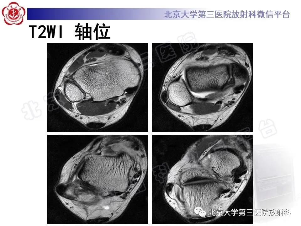 好文分享续集,腓骨肌腱脱位手术价格