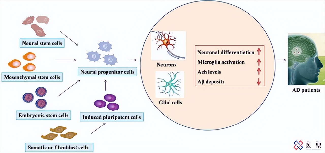 干细胞治疗阿尔茨海默病,日本干细胞疗法治疗脑血管病