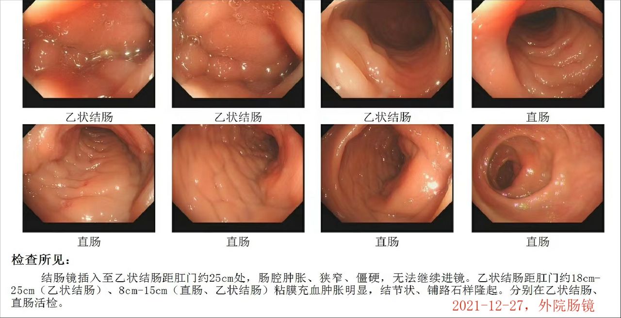 回肠克罗恩病可用阿达木治疗吗,克罗恩有肠瘘怎么动手术