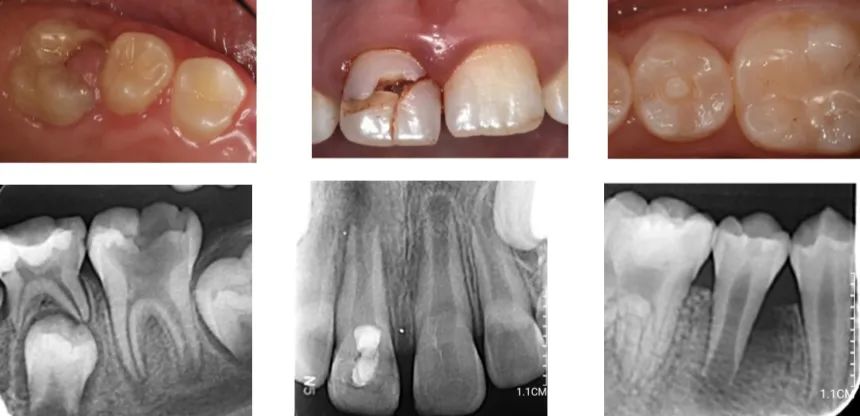18岁大门牙断牙修复最佳方法,大门牙缺了牙髓没了