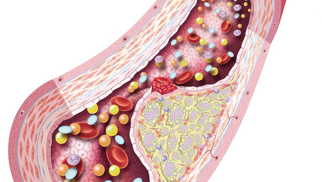 70岁动脉夹层第一层破裂能活多久,老人80了心脏动脉夹层破裂有救吗