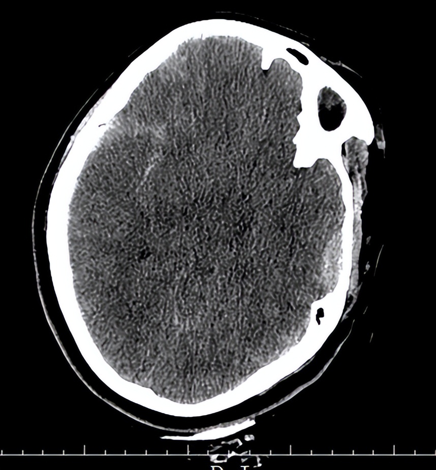 医院成功救治重型颅脑患者,特重型颅脑损伤治愈案