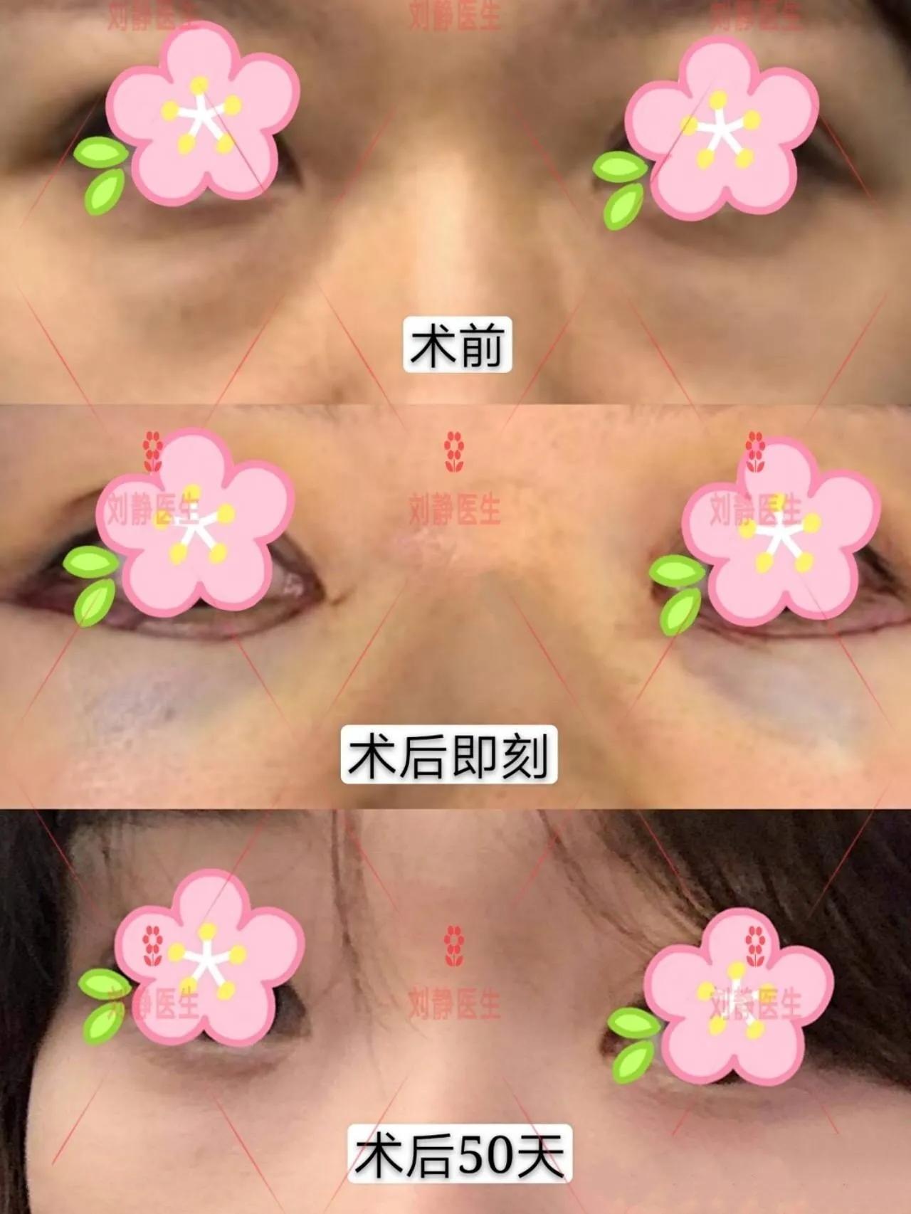 如何消除眼袋纹,如何消除眼袋最有效的方法男