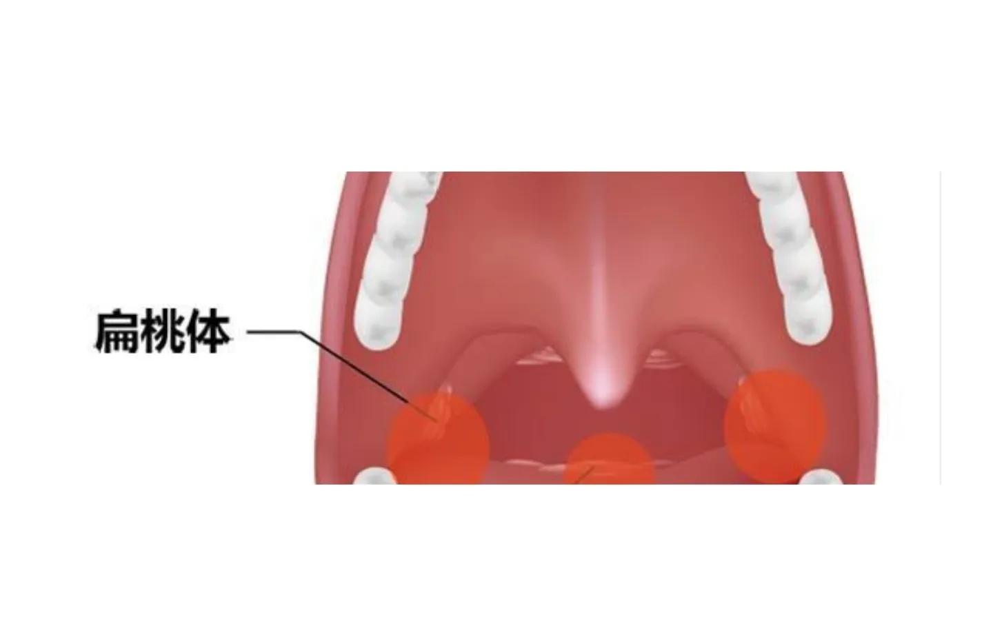 卡住鱼刺怎么办百试百灵,孩子被鱼刺卡住了怎么办