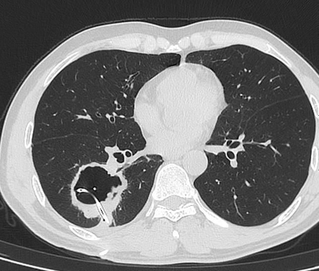 肺脓肿导管引流,肺脓肿的引流管脱落怎么办