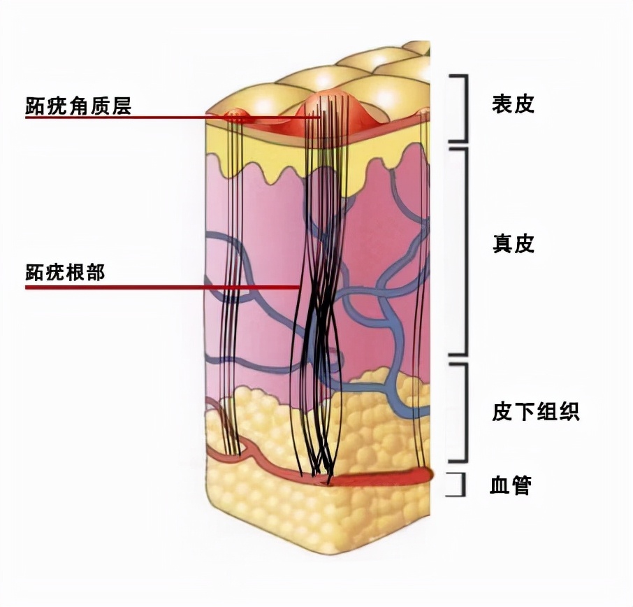 跖疣冷冻破了怎么办,跖疣反复冷冻不好怎么处理
