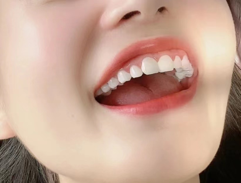 消除牙结石3个偏方轻松去除,5分钟快速去除牙结石