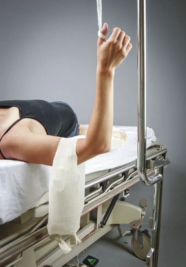 第一掌骨基底部骨折手法复位,骨折手法复位原理