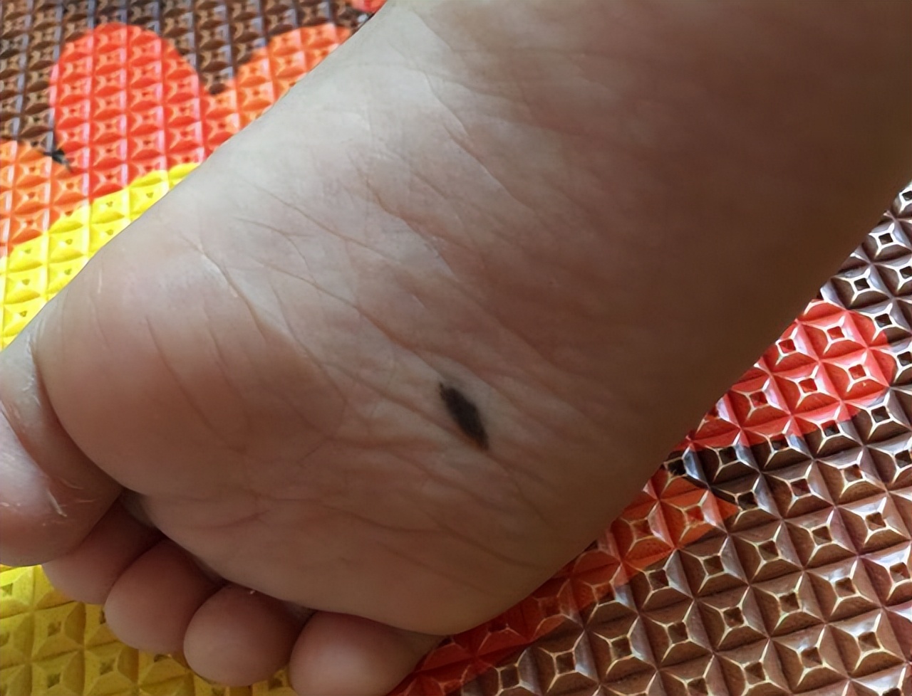 医生如何检查黑痣和黑色素瘤,医生长在摩擦部位的黑痣要当心