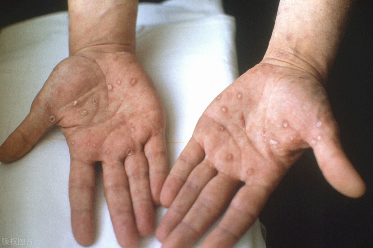 通过性传播的病有哪些不能治愈,通过性传播的疾病可以治愈吗