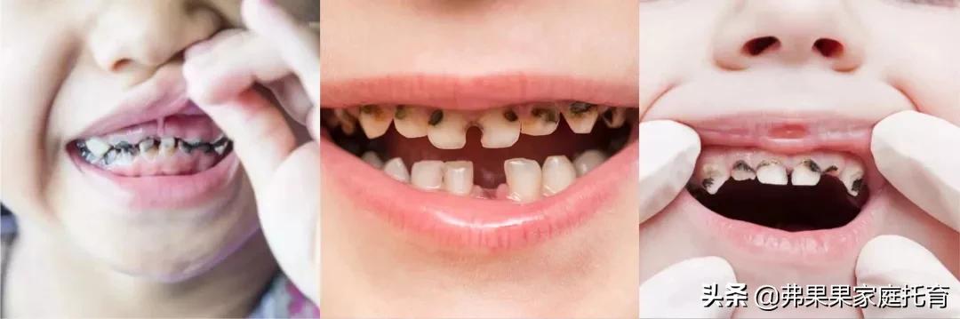 宝宝牙齿坏了一点怎么延缓发展,乳牙坏了没关系谈幼儿牙齿护理