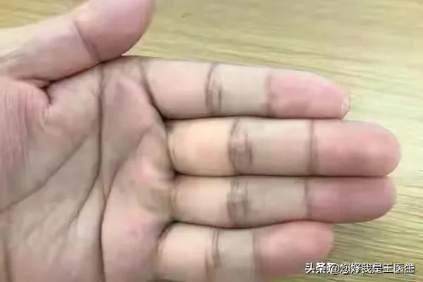 手指怎么测可以看出有没有得脑梗,手诊看掌纹