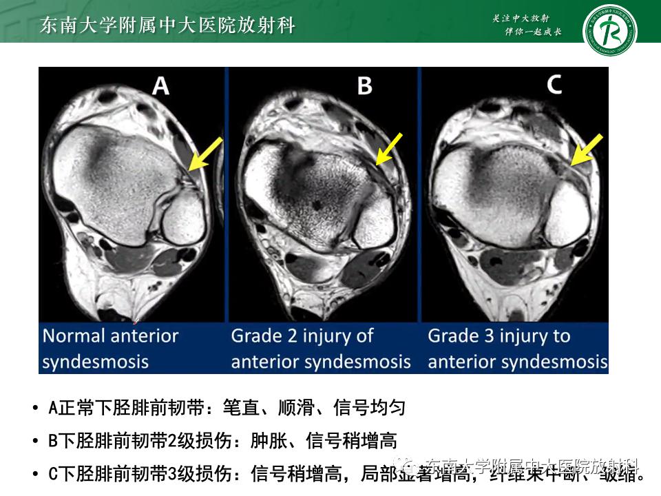 左腓骨下段骨折伴下胫腓联合分离,好文分享深度揭秘