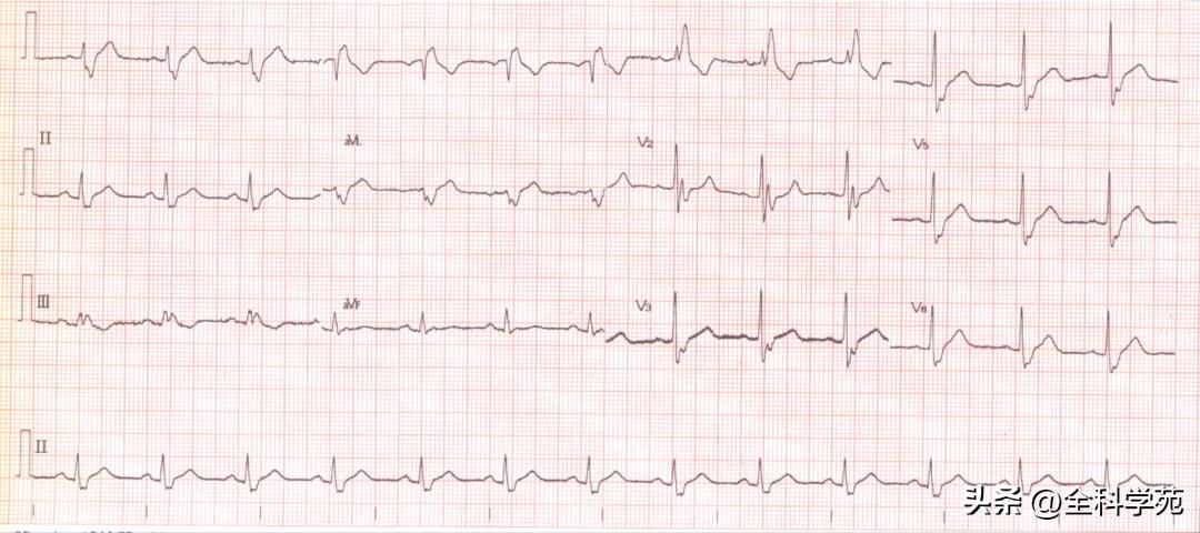 t波倒置三种常见原因,t波低平倒置有事吗