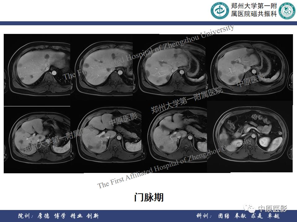 肝脏血管瘤样本,正确认识肝脏血管瘤文章