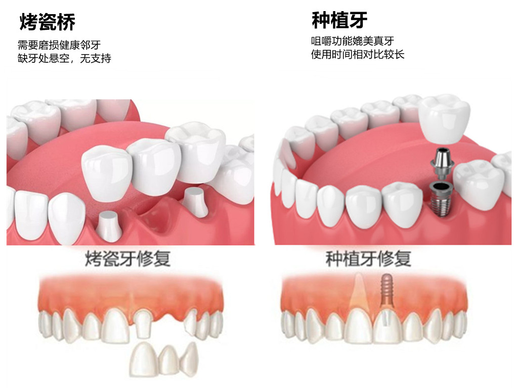 假牙怎么清理与保护用什么清洗,假牙戴时间长了有污垢怎么清理好