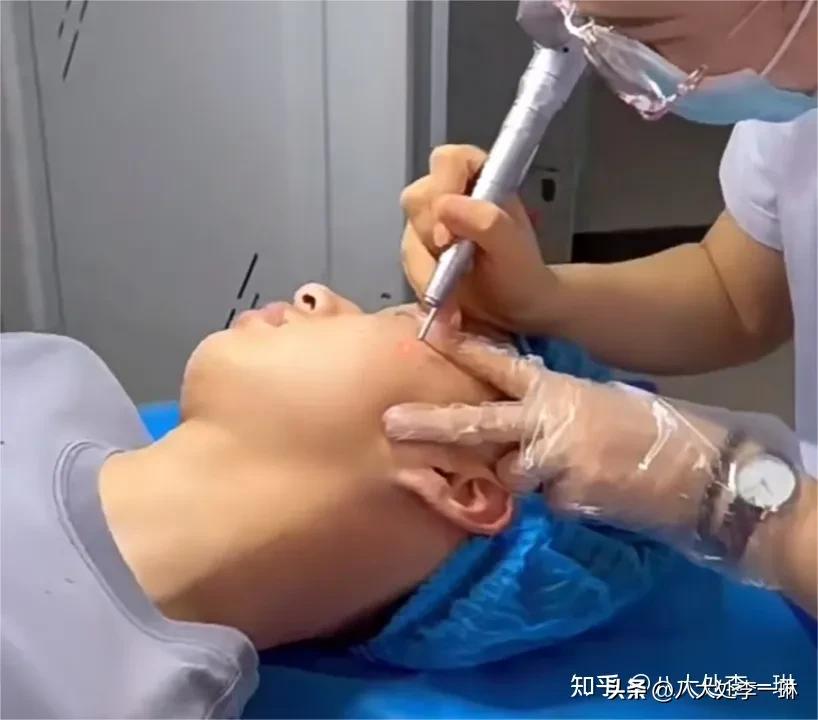 无色素痣怎么去除最好,什么是色素痣