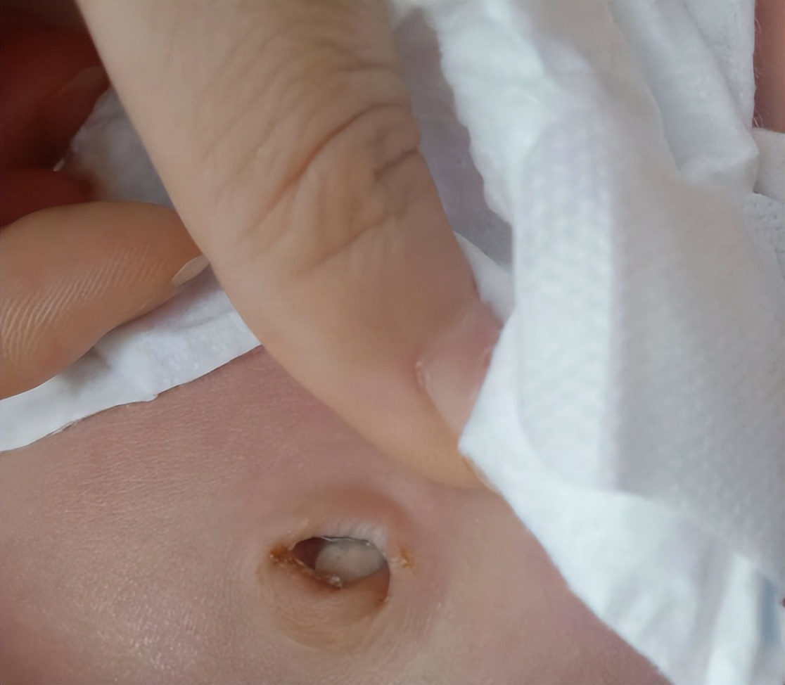 肚脐里的泥是什么能不能抠掉,肚脐眼里的黑泥是什么东西