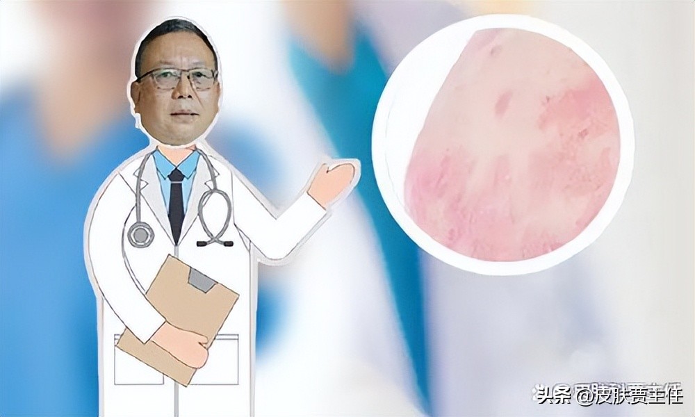 读完这篇文章，让你知道银屑病到底是什么，如何科学地来治疗